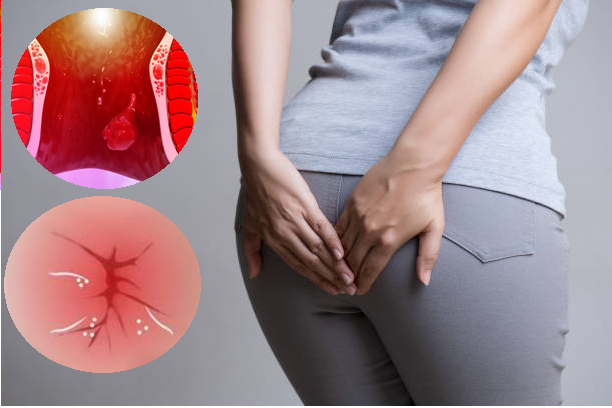 Cắt búi trĩ ít tái phát ở Thuận An