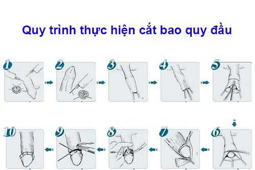 cắt bao quy đầu không đau Thuận An